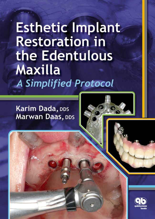 Dada: Esthetic Implant Restoration in the Edentulous Maxilla