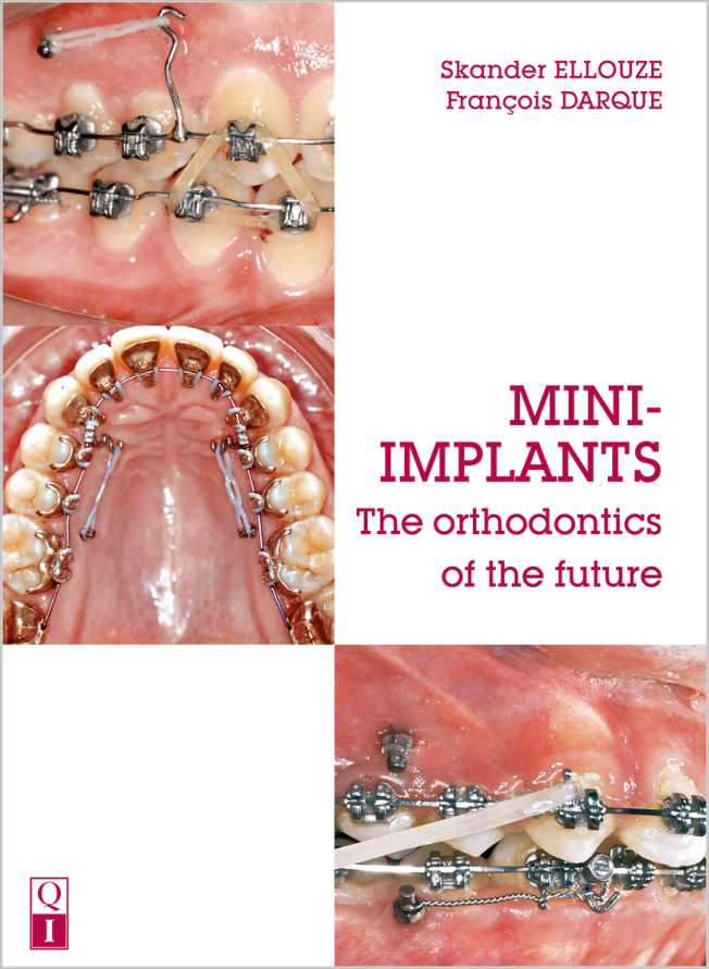 Ellouze: Mini-Implants