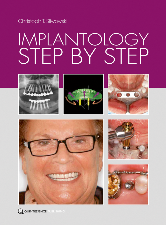 Sliwowski: Implantology Step by Step