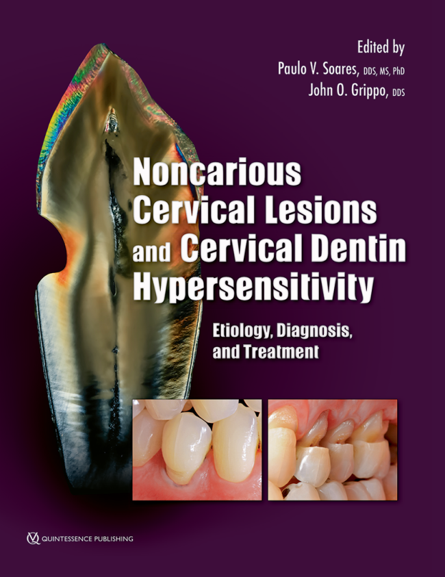 Soares: Noncarious Cervical Lesions and Cervical Dentin Hypersensitivity