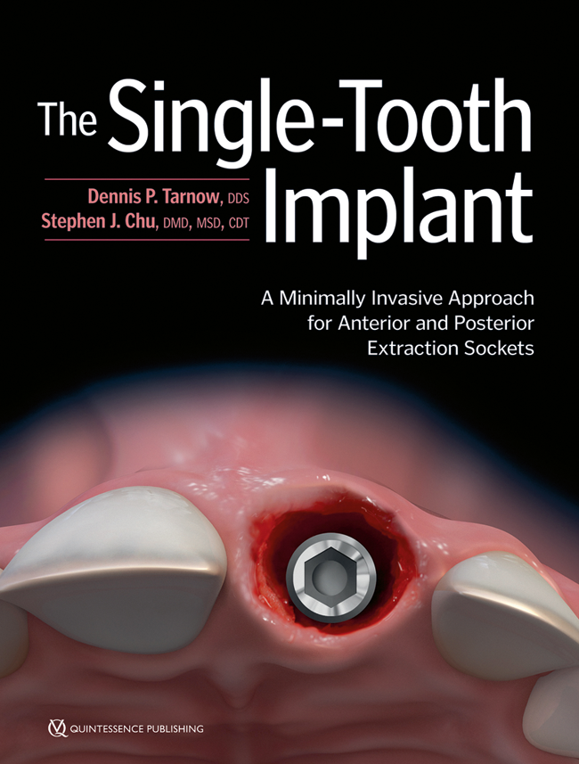 Tarnow: The Single-Tooth Implant