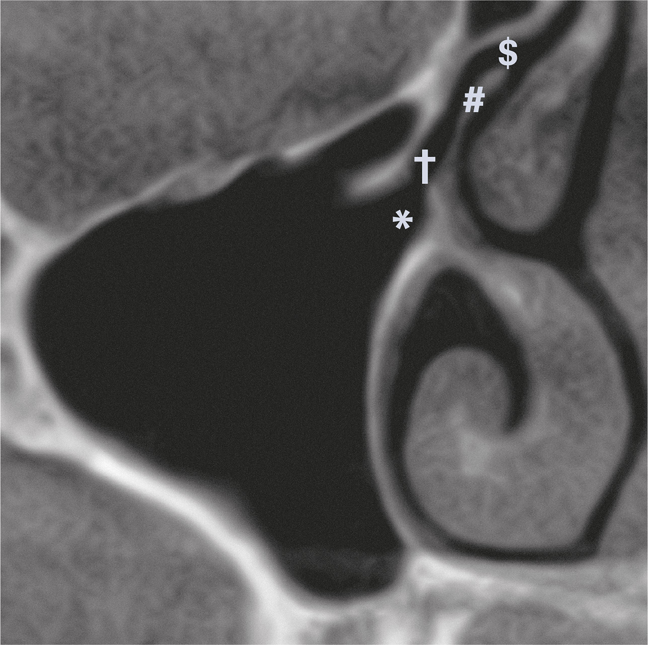 Abb. 1d DVT – koronale Ansicht. Darstellung des ostiomeatalen Komplexes rechts. Beachte das Ostium der Kieferhöhle (*), das Infundibulum ethmoidale (†), den Processus uncinatus (#) und den Hiatus semilunaris ($).