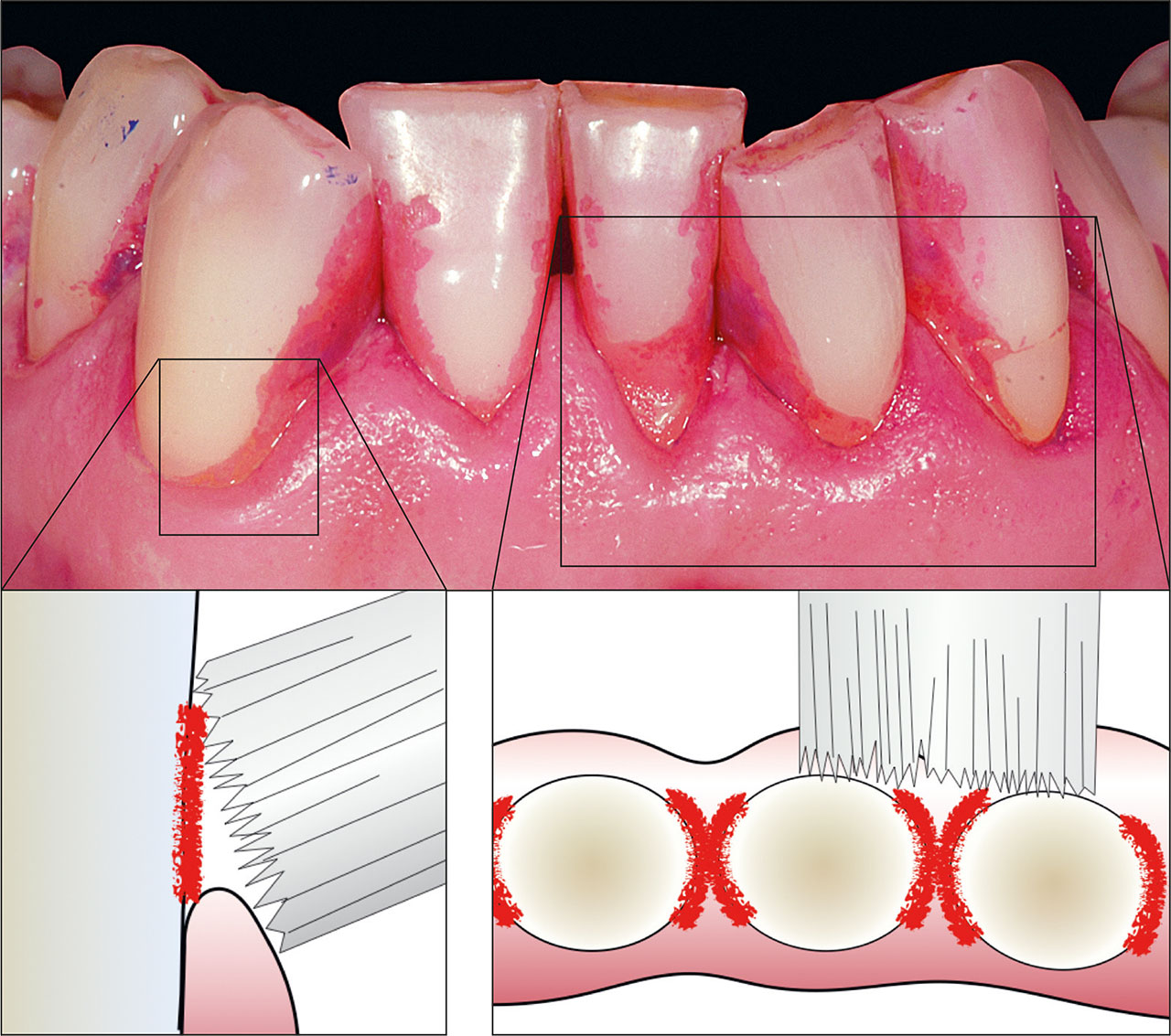Abb. 7 Klassische Plaqueverteilung bei Verwendung herkömmlicher Zahnbürsten mit planem Borstenfeld. Im Bereich, der bei Gesunden von der Interdentalpapille eingenommen wird („schwarze Dreiecke“), und in der Übergangsregion zum Margo gingivae kann Plaque häufig nicht effizient entfernt werden, sofern der Patient nicht über eine hervorragende manuelle Geschicklichkeit verfügt. In diesen gingivanahen Bereichen ist mit einer deutlichen Entzündungsreaktion und Plaqueansammlung zu rechnen.