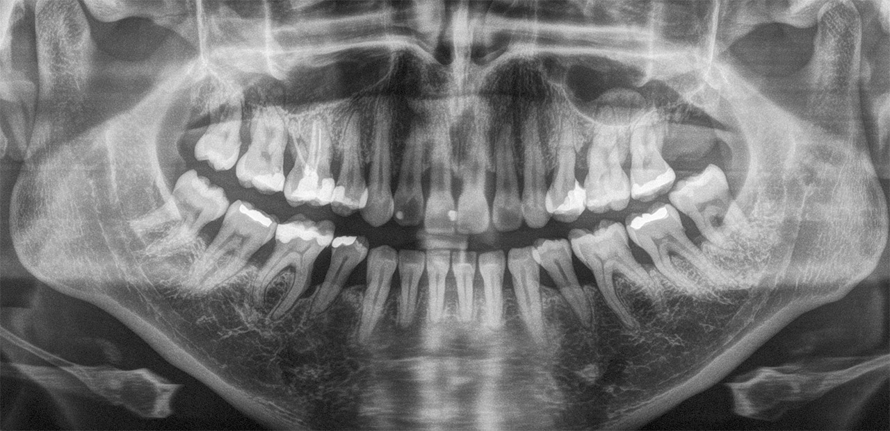 Abb. 4 Panoramaschichtaufnahme eines deutlich parodontal geschädigten Gebisszustands mit ausgeprägtem Knochenabbau und vereinzelten tiefen knöchernen Taschen.