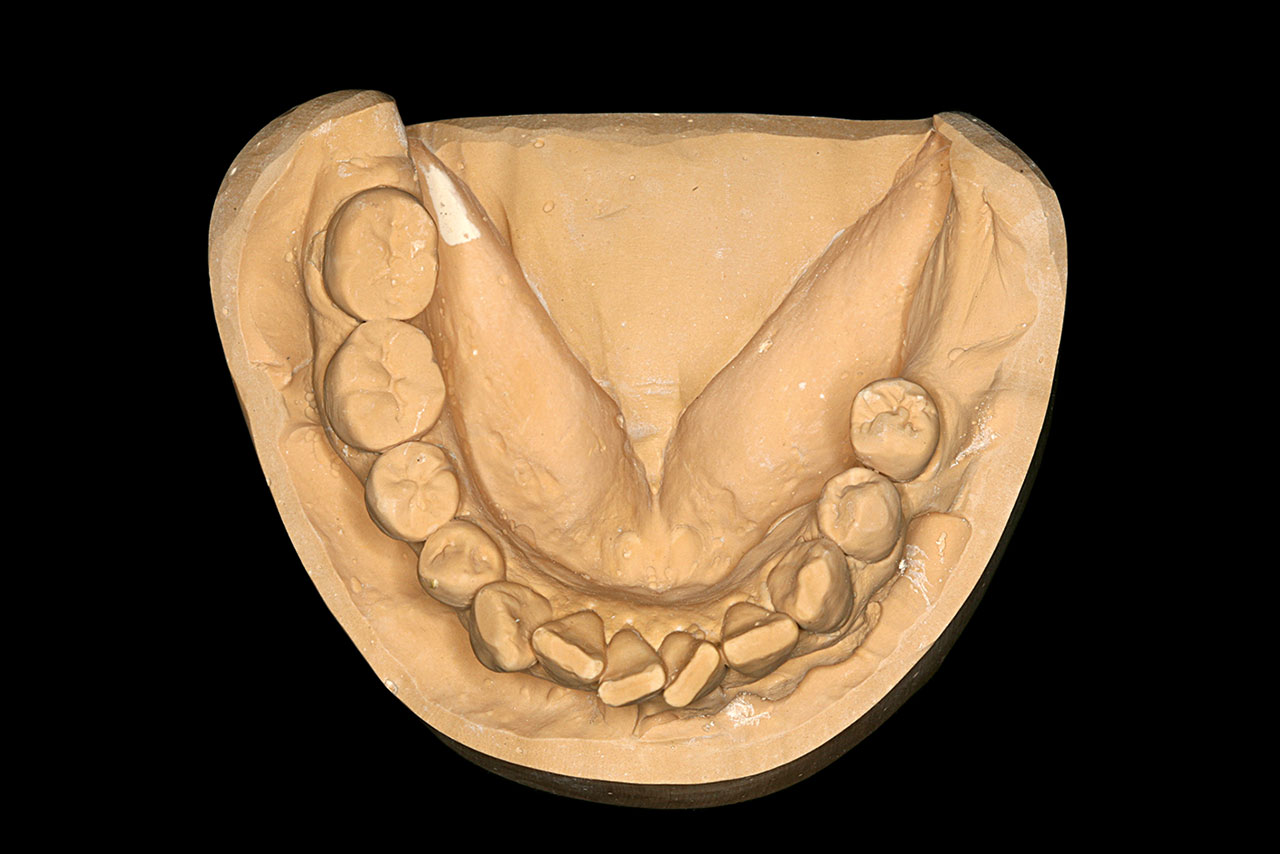 Abb. 1 Diagnostisches Modell der Ausgangssituation.  Der erste Molar im rechten Unterkiefer ist nicht erhaltungs­würdig. Die Zahnachsen der Nachbarzähne weisen in bukkolingualer Richtung eine starke Divergenz auf.