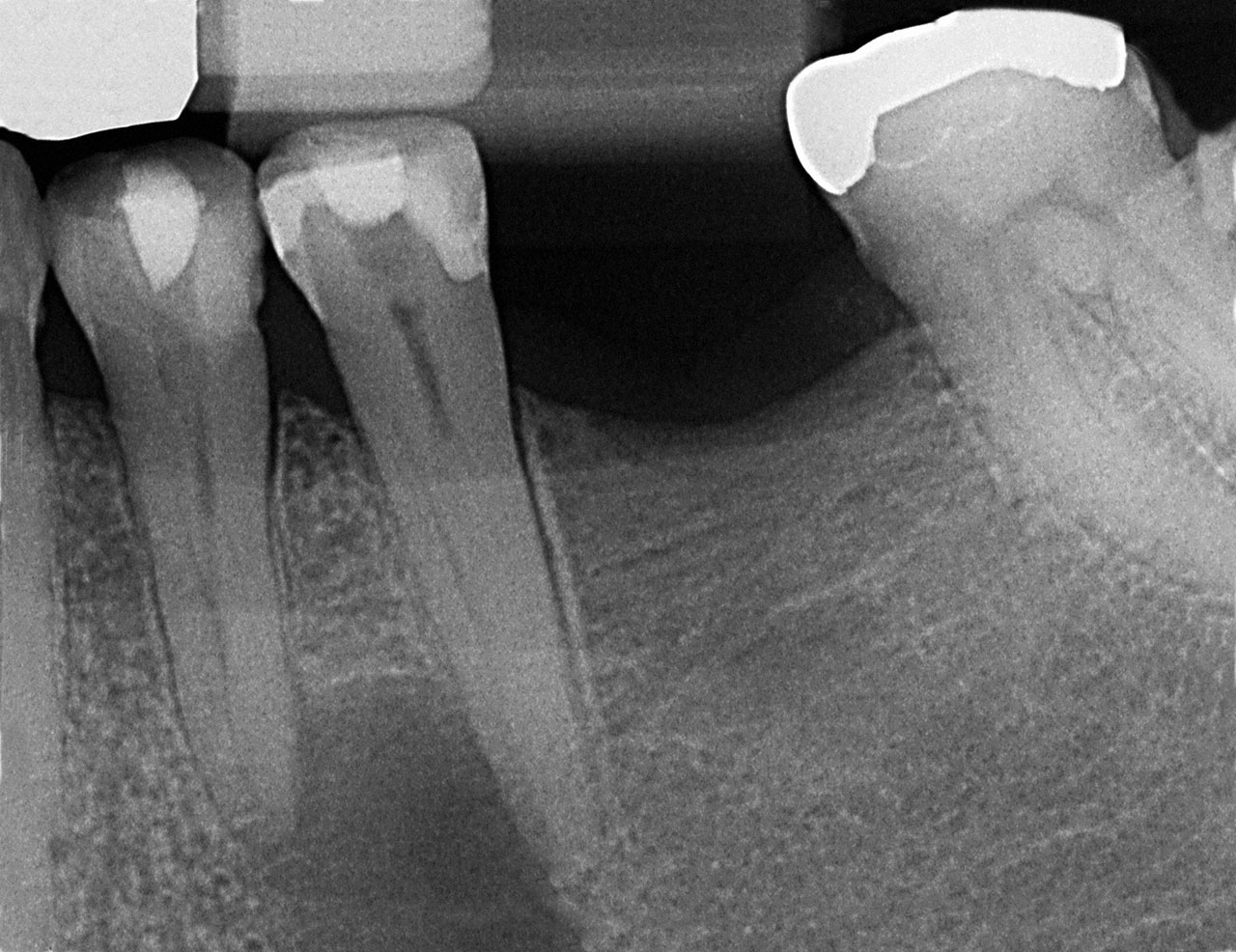 Abb. 1 Ausgangsröntgenaufnahme der Zähne 34 und 35.