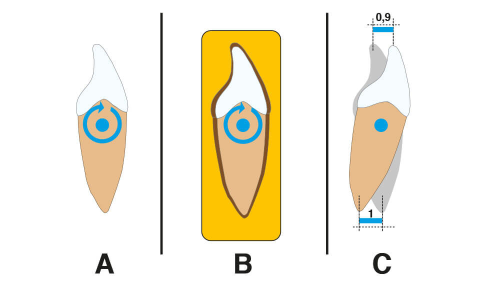 Abb. 1  Drehmomentreaktion eines starren Körpers. A: Das blaue Torquemoment dreht einen freien starren Körper (z. B. einen extrahierten Zahn auf dem Tisch) um seinen Schwerpunkt. Der blaue Schwerpunkt ist die Torqueachse. B: Das blaue Torquemoment dreht auch einen homogen und isotrop über das braune Parodontium im gelben Knochen aufgehängten Zahn um seinen Schwerpunkt. Der blaue Schwerpunkt ist auch hier die Torqueachse und derselbe Punkt wie beim freien Körper. C: Der Zahn bleibt in beiden Fällen an Ort und Stelle stehen und bewegt sich nicht fort. Lediglich Inzision und Apexpunkt „wandern“ in verschiedene Richtungen.