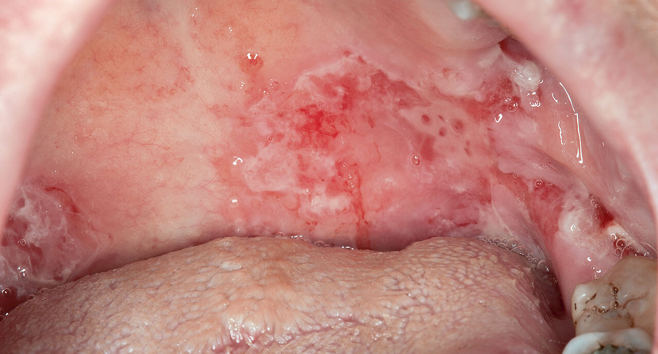 Abb. 7 Intraorale dünnwandige Blasen/Erosionen als erstes Zeichen eines Pemphigus vulgaris am weichen Gaumen einer 73-jährigen Patientin.