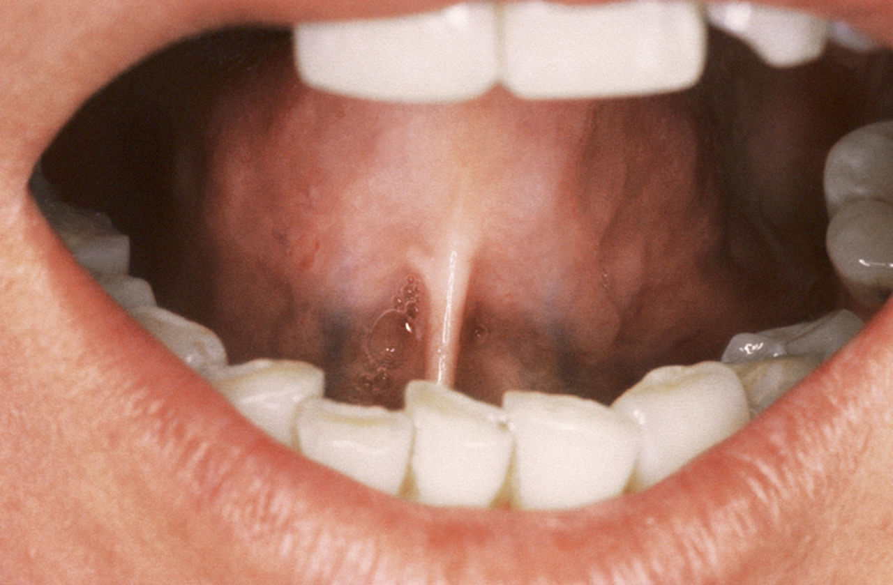 Abb. 8 Verkürztes wächsern erscheinendes Zungenbändchen (Skleroglosson) bei einer 30-jährigen Patientin mit systemischer Sklerose.
