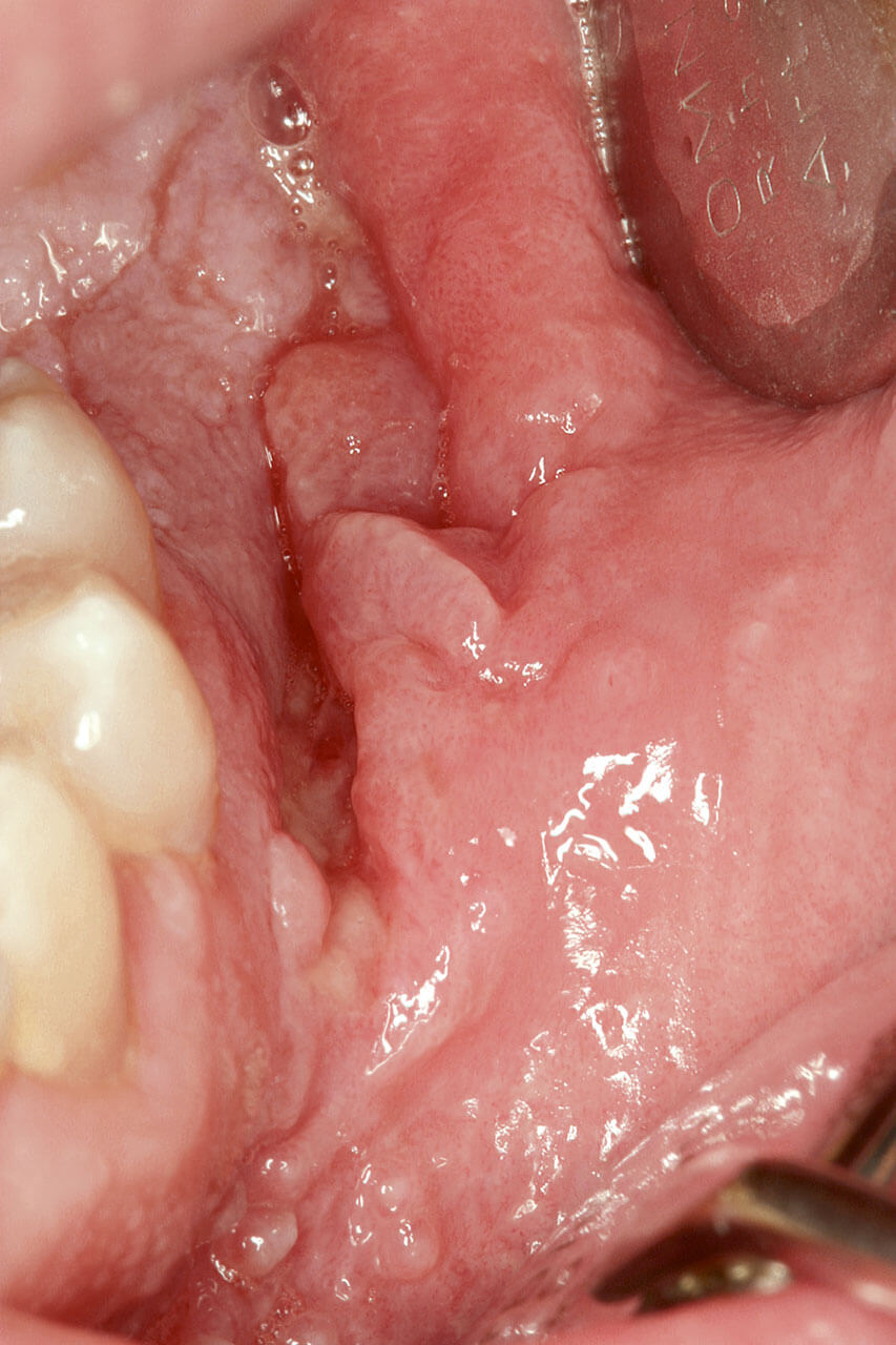 Abb. 9 44-jähriger Patient mit proliferierendem Gewebe im linken Vestibulum des Unterkiefers als Zeichen eines Morbus Crohn (Enteritis regionalis).