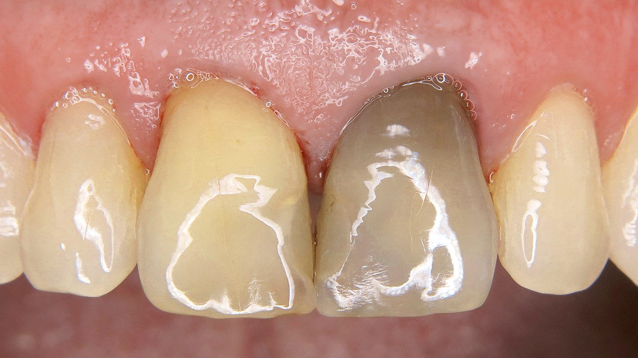 Zahn verfärbt sich grau kind